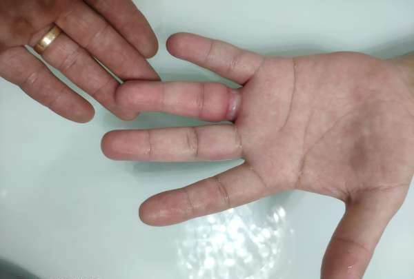 Bombeiros removem aliança que ficou presa em dedo de homem na Capital -  Secretaria da Segurança Pública e Defesa Social